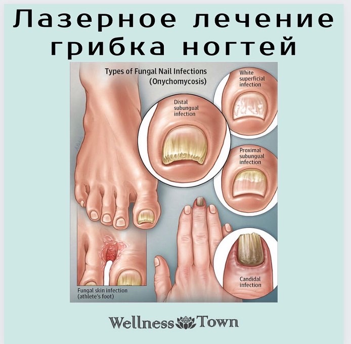 Онихомикоз (грибок ногтей) - причины, лечение, профилактика - Евромед